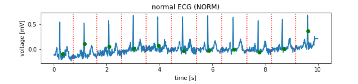 ECG time series segmented into heartbeat cycles (source)